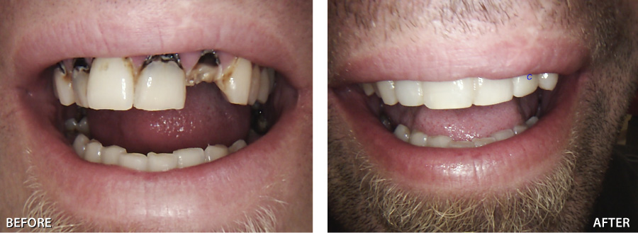 rotten teeth before and after